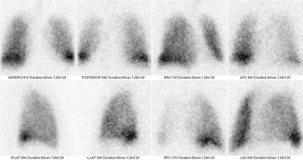 Obr. . 2: Ventilan scintigrafie plic na dvoudetektorov tomografick kamee