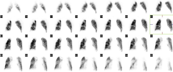 Obr. . 3: Perfuzn tomografick scintigrafie plic na dvoudetektorov tomografick kamee, vybrny koronln ezy