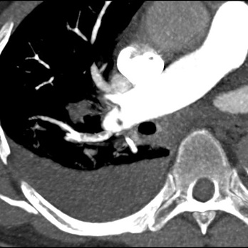 Obr. . 4: CT plicn angiografie