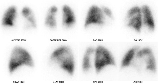 Obr. . 3: Perfuzn scintigrafie plic na dvoudetektorov tomografick kamee