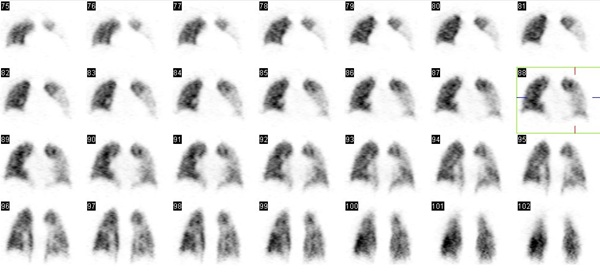 Obr. . 4: Perfuzn tomografick scintigrafie plic na dvoudetektorov tomografick kamee, vybrny koronln ezy