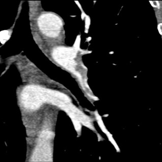 Obr. . 5: CT plicn angiografie