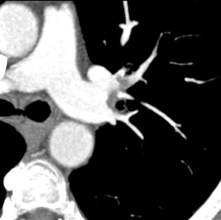 Obr. . 6: CT plicn angiografie