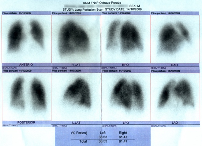 Obr. č. 2: Perfuzní scintigrafie plic provedená na dvoudetektorové tomografické scintilační kameře