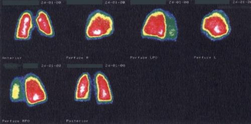 TechneScan LyoMAA: perfzn scintigrafie plic