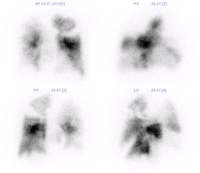 Obr. č. 1: Primární vyšetření – mnohočetné defekty perfuse oboustranně při TEN ad pulmonum.