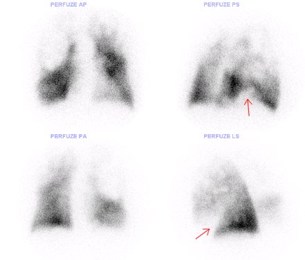 Obr. č. 1: Perfuzní scintigrafie plic – šipkou označeny defekty perfuze v rámci TEN ad pulm.