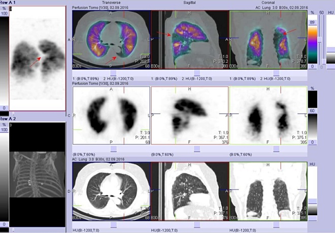 Obr. č. 3: Perfuzní scintigrafie plic - hybridní zobrazení SPECT/CT, fúze obrazů