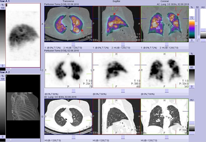 Obr. č. 4: Perfuzní scintigrafie plic - hybridní zobrazení SPECT/CT, fúze obrazů