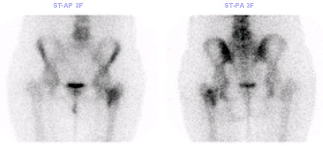Obr. č. 4: Cílené snímky kyčelních kloubů.