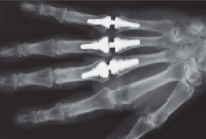 Obr. . 2: Rtg snmek ruky pacienta skloubnmi implantty III. a V. MCP kloubu.