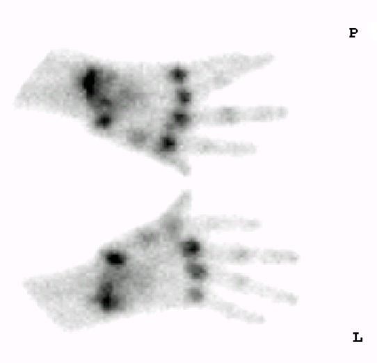 Obr. 4: Vyeten z r. 2012 - scintigram rukou v kostn fzi.