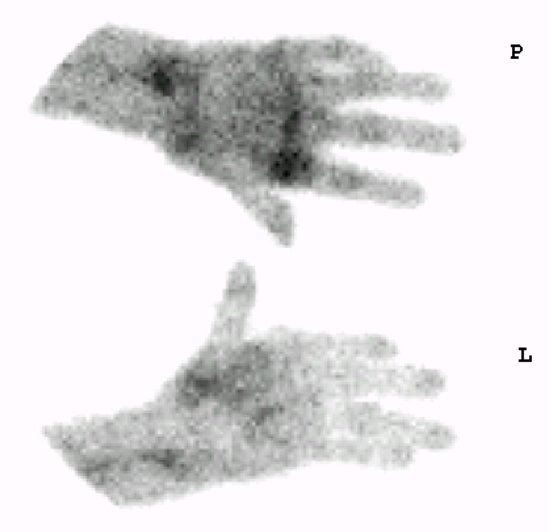 Obr. 5: Vyeten ze z 2015 - suman scintigram rukou vperfuzn fzi.