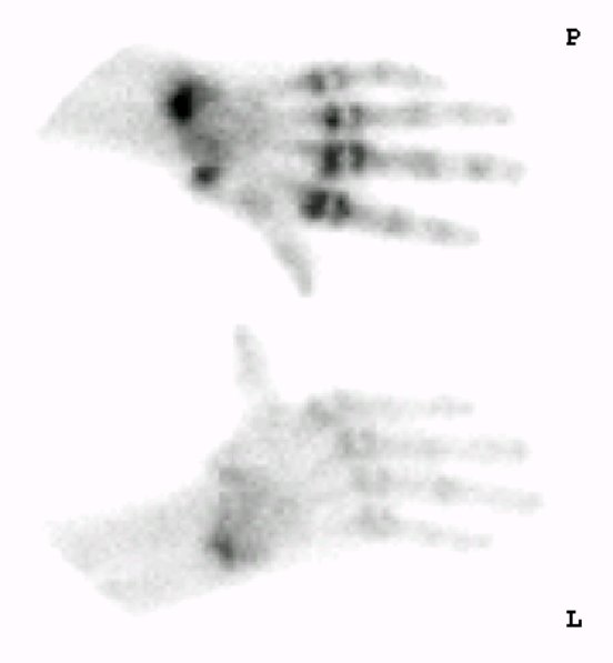 Obr. 6: Vyeten ze z 2015 -  scintigram rukou v kostn fzi.
