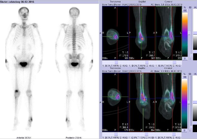 Obr. č. 3: Celotělová scintigrafie v přední a zadní projekci a fúze obrazů SPECT a CT. Vpravo fúze obrazů SPECT a CT - zaměřeno na distální část levé fibuly - řezy transverzální, sagitální a koronální.