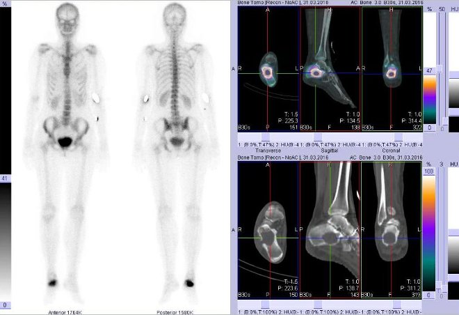 Obr.č.1: Celotělová scintigrafie v přední a zadní projekci a fúze obrazů SPECT a CT. Vpravo fúze obrazů SPECT a CT - zaměřeno na ložisko v pravé patní kosti. Řezy transverzální, sagitální a koronální.