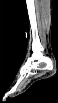 Obr.č.4: „low dose“ CT pravé nohy – sagitální  řez.