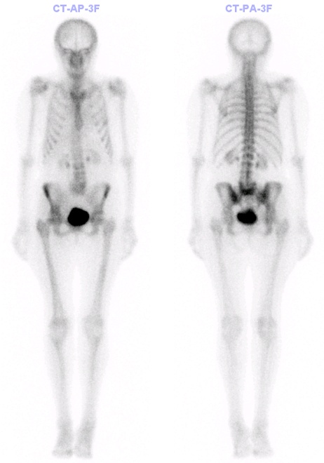 Obr. č. 3 – Celotělový scan, kostní fáze