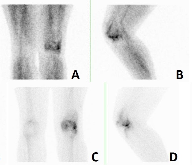 Obr.1.: Obraz zvýšeného krevního poolu v lemu kolem distálního konce levého femuru zejména laterálně v přední a levé bočné laterální projekci (A, B) a statické scany se zvýšenou depozicí RF v laterálním kondylu levého femuru v týchž projekcích (C, D). Nález odpovídá poškození kloubní plochy femuru s obrazem lehčí synovialitidy.