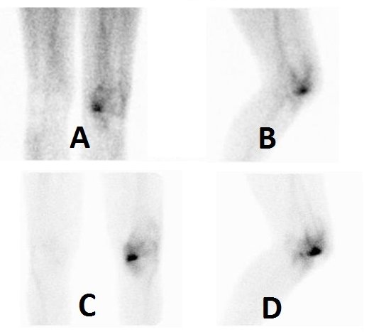 Obr.2.: Obraz zvýšeného krevního poolu v lemu kolem distálního konce levého femuru  mediálně  v přední a levé bočné mediální projekci  (A, B)  a statické scany se zvýšenou depozicí RF v mediálním kondylu levého femuru v týchž projekcích (C, D). Nález odpovídá poškození kloubní plochy femuru s obrazem lehčí synovialitidy.