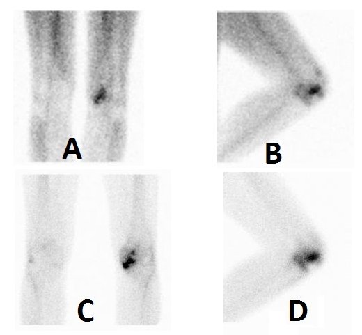 Obr.4.: Obraz zvýšeného krevního poolu fokálně a v lemu kolem distálního konce levého femuru mediálně v přední a levé bočné mediální projekci (A, B) a statické scany se zvýšenou depozicí RF v subchondrální lokalizaci na proximální tibii vlevo mediálně a na patele v týchž projekcích (C, D). Nález odpovídá artrotickým změnám a poškození kloubní plochy femuru mediálně v korelaci s RTG a s obrazem synovialitidy.