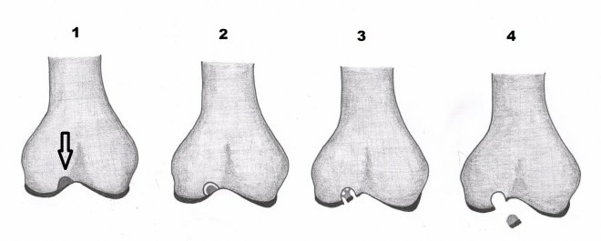 Obr.6.: Stádia disekující osteochondritidy 1-4. 1- vyznačená stabilní léze v kosti, 2 - naznačené odloučení fragmentu v kosti, 3 - fragmentace chrupavky, 4 - dislokace fragmentu s obrazem osteochondrálního defektu na LDCT.