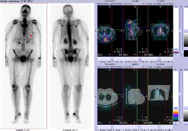 Obr. č. 2: Celotělové scintigramy a fúze obrazů SPECT a CT. Zaměřeno na ložisko v levém prsu. Řezy transverzální, sagitální a koronální.