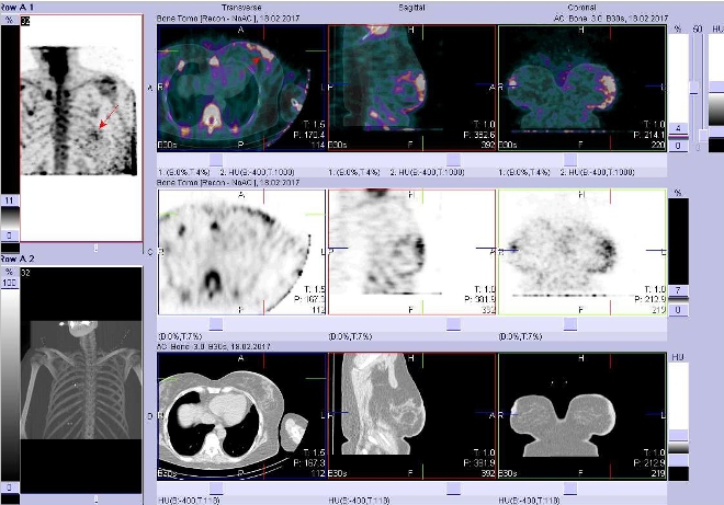 Obr. č. 2: Fúze obrazů SPECT a CT. Zaměřeno na ložisko v levém prsu. Řezy transverzální, sagitální a koronální. Nahoře fúze SPECT/CT, uprostřed SPECT, dole CT.