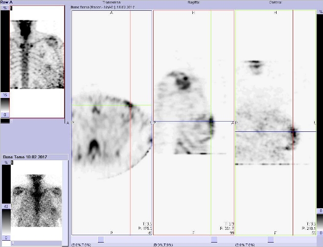 Obr. č. 3: Tomografická scintigrafie (SPECT) hrudníku. Zaměřeno na ložisko v levém prsu. Řez transverzální, sagitální a koronální.