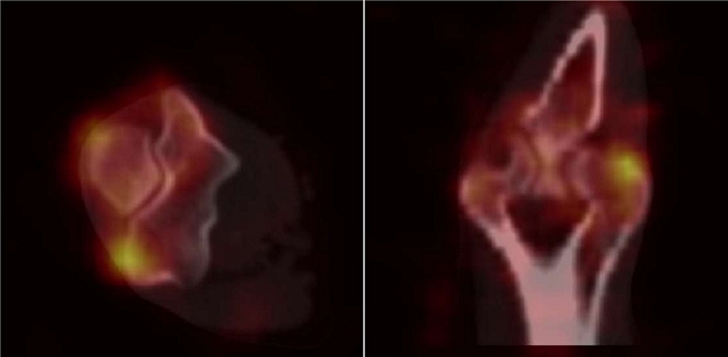 Obr.č.4: MIP SPECT/low dose CT pravého loketního kloubu s nálezem zvýšené akumulace radiofarmaka  v oblasti radiálního epikondylu – levý obrázek je v rovině transverzální, pravý v rovině koronární v supinační poloze ruky.
