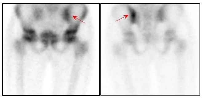Obr. č. 2: Třetí skeletální fáze s patologicky zvýšenou akumulací 99mTc-HDP v levém SI skloubení – levý obrázek je z přední, pravý ze zadní projekce.