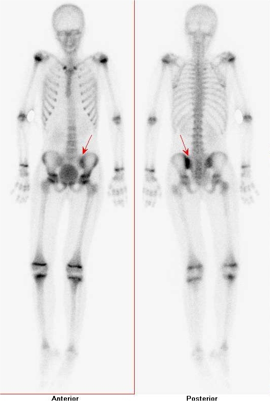Obr.č.3: Celotělová scintigrafie skeletu v přední a zadní projekci -  patologicky zvýšená akumulace 99mTc-HDP v levém SI skloubení, fyziologicky zvýšená akumulace v růstových zónách dlouhých kostí.