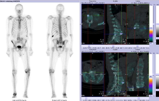 Obr.č.1: Celotělová scintigrafie v přední a zadní projekci a fúze obrazů SPECT a CT.  Vpravo zaměřeno na degenerativní ložiska v bederní páteři. Řezy transverzální, řezy sagitální a řezy koronální.