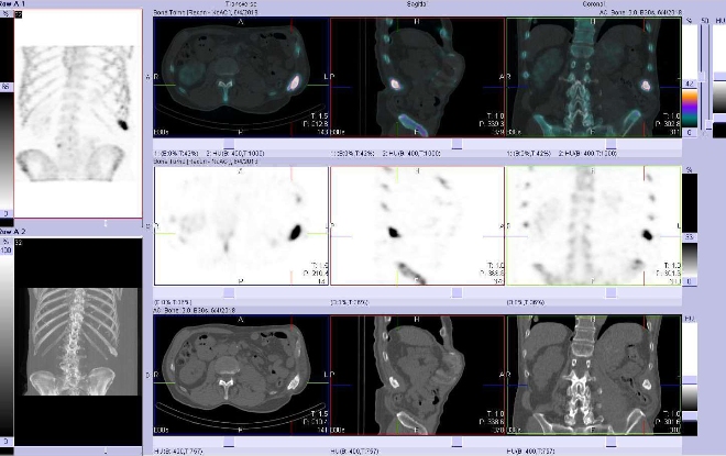 Obr. č. 2: Fúze obrazů SPECT a CT.  Zaměřeno na ložisko v dorzální části 11. žebra vlevo. Vpravo nahoře fúze SPECT/CT, vpravo uprostřed SPECT, vpravo dole CT. Řezy transverzální, řezy sagitální a řezy koronální.