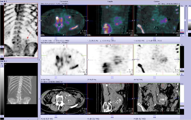 Obr.č.3: Fúze obrazů SPECT a CT.  Zaměřeno na měkkotkáňové ložisko v levém retroperitoneu paravertebrálně s okrsky kalcifikace. Vpravo nahoře fúze SPECT/CT, vpravo uprostřed SPECT, vpravo dole CT. Řezy transverzální, řezy sagitální a řezy koronální.