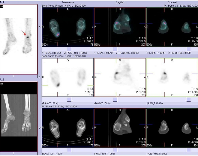 Obr. č. 3: SPECT/low dose CT s nálezem zvýšené akumulace radiofarmaka v oblasti tuber calcanei pravé patní kosti.