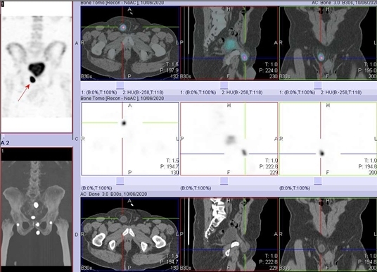 Obr. č. 2: SPECT/low dose CT s nálezem akumulace radiofarmaka v části močového měchýře, který je součástí inguinální hernie vpravo – viz šipka.