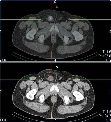 Obr. č. 3: Detail SPECT/low dose CT  fúzovaného snímku a  CT snímku v transverzálním řezu  s nálezem  akumulace radiofarmaka v močovém měchýři, který je součástí inguinální hernie vpravo.