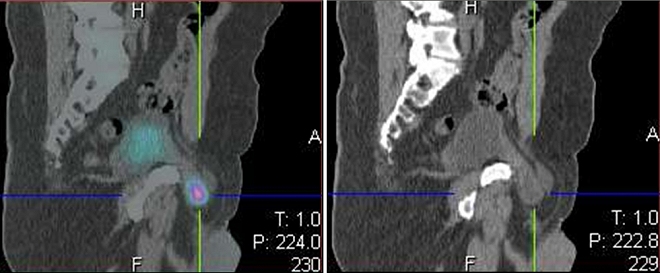 Obr.č.4: Detail SPECT/low dose CT  fúzovaného snímku a  CT snímku v sagitálním řezu s nálezem akumulace radiofarmaka v močovém měchýři, který je součástí  inguinální hernie vpravo.