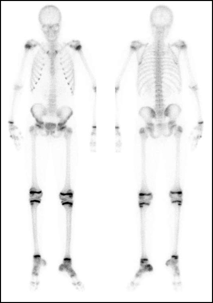 Obr. č. 2: Celotělová scintigrafie skeletu v přední a zadní projekci s nálezem mírně zvýšené akumulace radiofarmaka v dorsální části patní kosti vlevo.