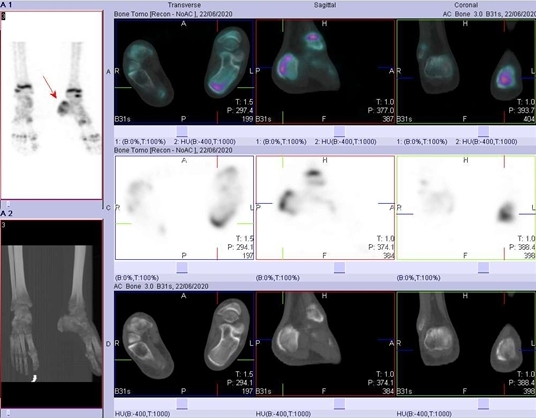 Obr. č. 3: SPECT/low dose CT s nálezem zvýšené akumulace radiofarmaka v dorsální části patní kosti vlevo.