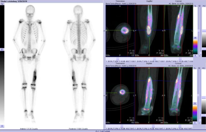 Obr. č. 1: Celotělová scintigrafie v přední a zadní projekci a fúze obrazů SPECT a CT. Vpravo zaměřeno na ložisko v levé stehenní kosti. Řezy transverzální, sagitální a koronální.
