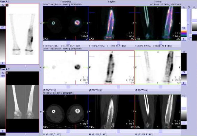 Obr. č. 2: Fúze obrazů SPECT a CT stehenních kostí a kolenních kloubů – vpravo nahoře fúze obrazů SPECT/CT, vpravo uprostřed SPECT a vpravo dole CT. Řezy transverzální, sagitální a koronální.