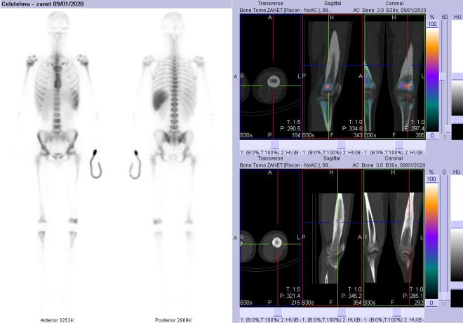 Obr. č. 3: Celotělová scintigrafie v přední a zadní projekci a fúze obrazů SPECT a CT za 4 hod. po aplikaci radiofarmaka. Vpravo zaměřeno na levou stehenní kost.