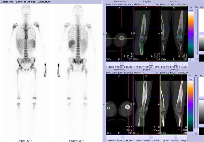 Obr. č. 4: Celotělová scintigrafie v přední a zadní projekci a fúze obrazů SPECT a CT za 24 hod. po aplikaci radiofarmaka. Vpravo zaměřeno na levou stehenní kost.