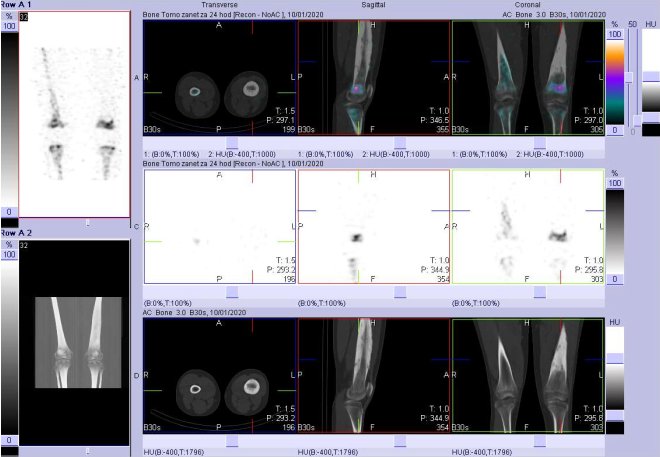 Obr. č. 5: Fúze obrazů SPECT a CT stehenních kostí a kolenních kloubů – vpravo nahoře fúze obrazů SPECT, vpravo uprostřed SPECT a vpravo dole CT. Řezy transverzální, řezy sagitální a řezy koronální.