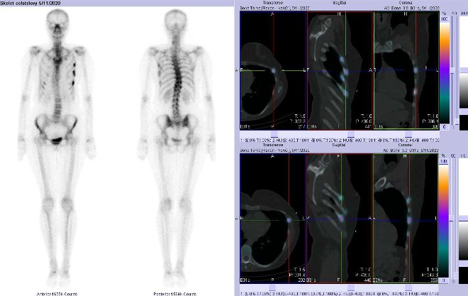 Obr. č. 1: Celotělová scintigrafie v přední a zadní projekci a fúze obrazů SPECT a CT.  Vpravo zaměřeno na  ložiska v laterální části  6. a 7. žebra vlevo. Řezy transverzální,  sagitální a koronální.