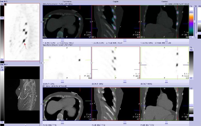 Obr. č. 2: Fúze obrazů SPECT a CT.  Zaměřeno na ložisko v v laterální části  8. žebra vlevo. Vpravo nahoře fúze SPECT/CT, vpravo uprostřed SPECT, vpravo dole CT. Řezy transverzální, sagitální a koronální.