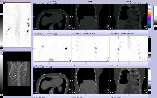 Obr. č. 4: Fúze obrazů SPECT a CT.  Zaměřeno na ložisko ve ventrolaterální části jednoho žebra vpravo. Vpravo nahoře fúze SPECT/CT, vpravo uprostřed SPECT, vpravo dole CT. Řezy transverzální, sagitální a koronální.