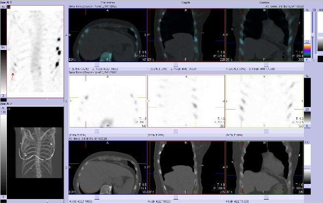 Obr. č. 5: Fúze obrazů SPECT a CT.  Zaměřeno na ložisko ve ventrolaterální části jednoho žebra vpravo. Vpravo nahoře fúze SPECT/CT, vpravo uprostřed SPECT, vpravo dole CT. Řezy transverzální, sagitální a koronální.